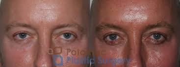 blepharoplasty eyelid surgery for