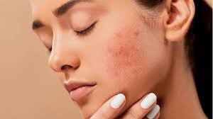 10 home remes to treat acne india