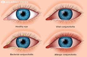pink eye conjunctivitis all about