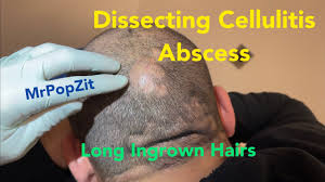long ingrown hairs incision