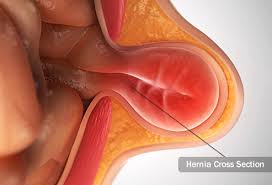Visual Guide To Hernias