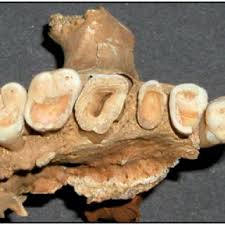 Increasing tooth wear according to time of eruption. Pulp exposure in... | Download Scientific Diagram