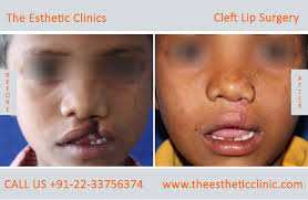 cleft lip surgery in india best cleft