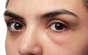 what causes puffiness under the eyes