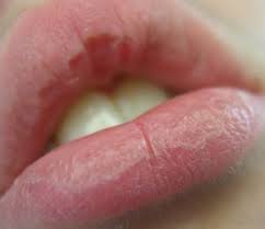treat chapped lips naturally outdoor