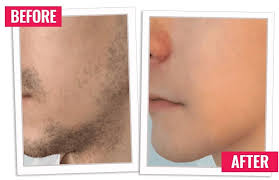 permanent hair removal cream hairfree
