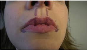 evert the upper lip by filling the
