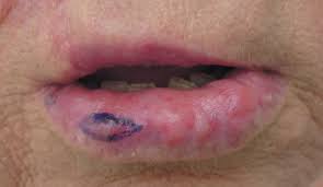 nontender nodules on the lower lip
