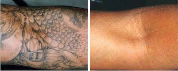 It is advised to do a thorough study of tattoo removal methods that best suits you, and compare their costs. Is Tattoo Removal Safe 5 Methods Reviewed London Premier Laser