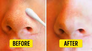 get rid of blackheads on nose