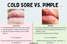 cold sore vs pimple pictures and