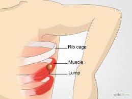 What causes right upper quadrant pain under ribs? How To Check Lymph Nodes 10 Steps With Pictures Wikihow Lymph Nodes Lymph Nodes Armpit Swollen Lymph Nodes Armpit