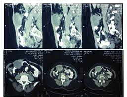 While hormone therapy can lower your pain, it isn't a cure for endometriosis. Can A Ct Scan Show Endometriosis Ct Scan Machine