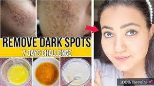 in 7 days remove dark spots acne
