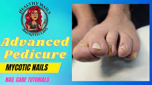how to care for mycotic pincer nails