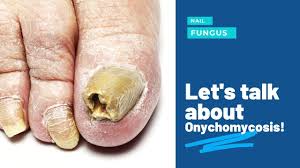 get rid of unsightly fungal toenails