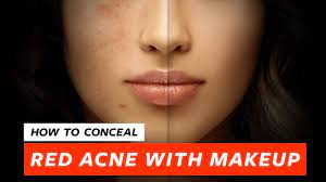 how to conceal red pimples acne for