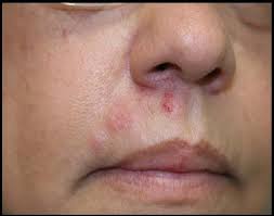 herpes zoster shingles zoster zona