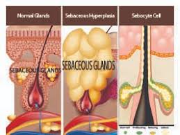 sebaceous hyperplasia gaining the