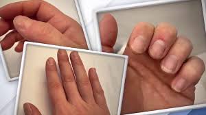 7 nail symptoms and conditions you
