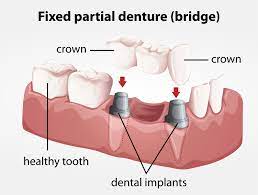 what are fixed partial dentures los