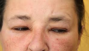 allergic reaction to eye makeup