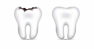 مراحل تسوس الاسنان عند الاطفال بالتفصيل |