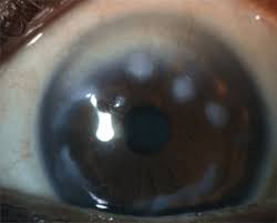 Patients with epithelial basement membrane dystrophy have poorly adherent corneal epithelium and are predisposed to epithelial sloughing during the microkeratome pass of laser in situ keratomileusis. Not The Usual Suspects