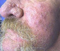 Dans ce type d'acné rosacée, on voit l'apparition de papules mais surtout de pustules. Dermato Info La Couperose Et La Rosacee