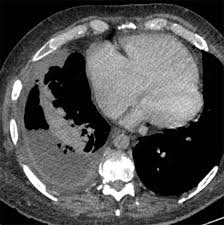 1 imaging findings are useful for the diagnosis, but the final diagnosis is confirmed with histological examination. The Role Of Imaging In Malignant Pleural Mesothelioma An Update After The 2018 Bts Guidelines Clinical Radiology