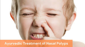 nasal polyps causes symptoms and