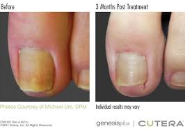 cutera genesis toenail fungus treatment