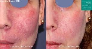 vbeam perfecta laser skin treatment