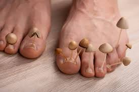 can you treat foot fungus at home
