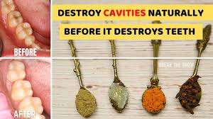 reverse cavities and heal tooth decay