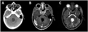 pediatric neuro oncology