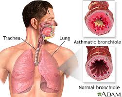 How can you lessen the severity of an asthma attack and/or stop it altogether without your trusty inhaler? Asthmatic Bronchiole And Normal Bronchiole Medlineplus Medical Encyclopedia Image