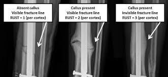 tibial shaft fractures