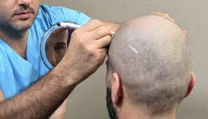 تكلفة زراعة الشعر في تركيا 2021: زراعة الشعر بأقل الأسعار | البرنس ترافل