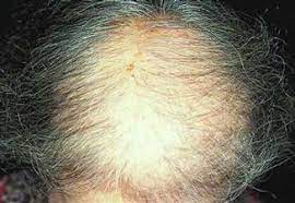 hair loss in the elderly springerlink