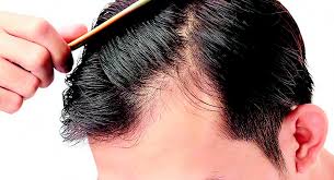 Alopecia areata may be hereditary and isn't contagious. Hair Transplant One Option In Alopecia Don T Put Off Your Wish Portugal Resident