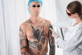 laser tattoo removal in tucson az