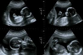 Bei dem ersten ultraschall stehen lage, größe & gesundheit des babys auf dem prüfstand. Welche Storungen Kann Man Im Ultraschall Erkennen Ultraschalluntersuchungen Untersuchungen Medizinisches Schwangerschaft Swissmom Ch