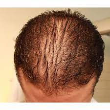 stem cell therapy for hair regrowth at
