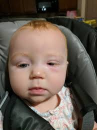 swollen skin under eye babycenter