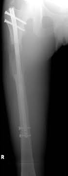 bone fixation in limb lengthening