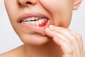 when to be concerned about swollen gums
