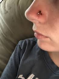 Nose piercing infection may take a long time to heal. Super Infected Nose Piercing Update 5 Babycenter