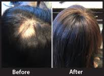 trichotillomania alternative hair