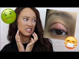 bed stye chalazion care storytime